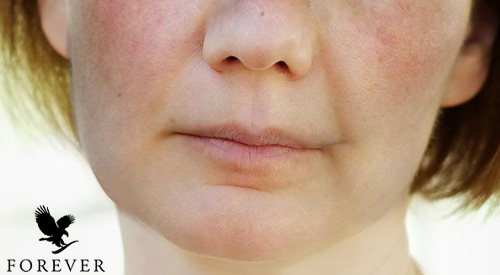 علائم بیماری لوپوس